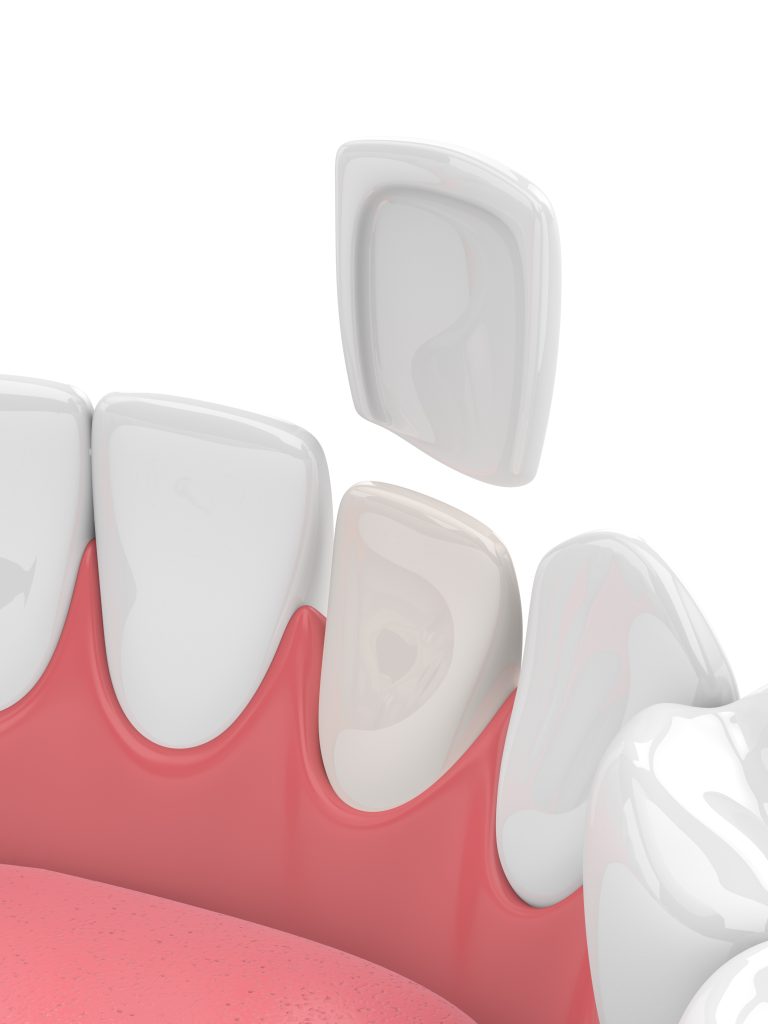 Dentist in North Palm Beach, Dentist in Palm Beach Gardens, Dentist in Juno Ridge, Dentist in Jupiter, Dentist West Palm Beach, Dentist in Lake Park, Dentist in Riviera Beach, Dentist in Cabana Colony, Dental Implant in North Palm Beach, Dental Implants in Palm Beach Gardens, Dental Implants in Riviera Beach, Dental Implants West Palm Beach, Emergency Dentist North Palm Beach, Emergency Dentist in West Palm Beach, Emergency Dentist in Palm Beach Gardens PORCELAIN VENEERS