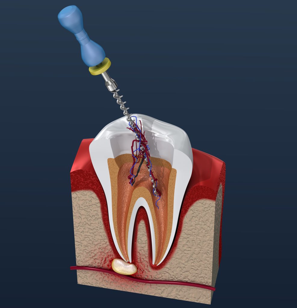 Dentist in North Palm Beach, Dentist in Palm Beach Gardens, Dentist in Juno Ridge, Dentist in Jupiter, Dentist West Palm Beach, Dentist in Lake Park, Dentist in Riviera Beach, Dentist in Cabana Colony, Dental Implant in North Palm Beach, Dental Implants in Palm Beach Gardens, Dental Implants in Riviera Beach, Dental Implants West Palm Beach, Emergency Dentist North Palm Beach, Emergency Dentist in West Palm Beach, Emergency Dentist in Palm Beach Gardens root canal therapy