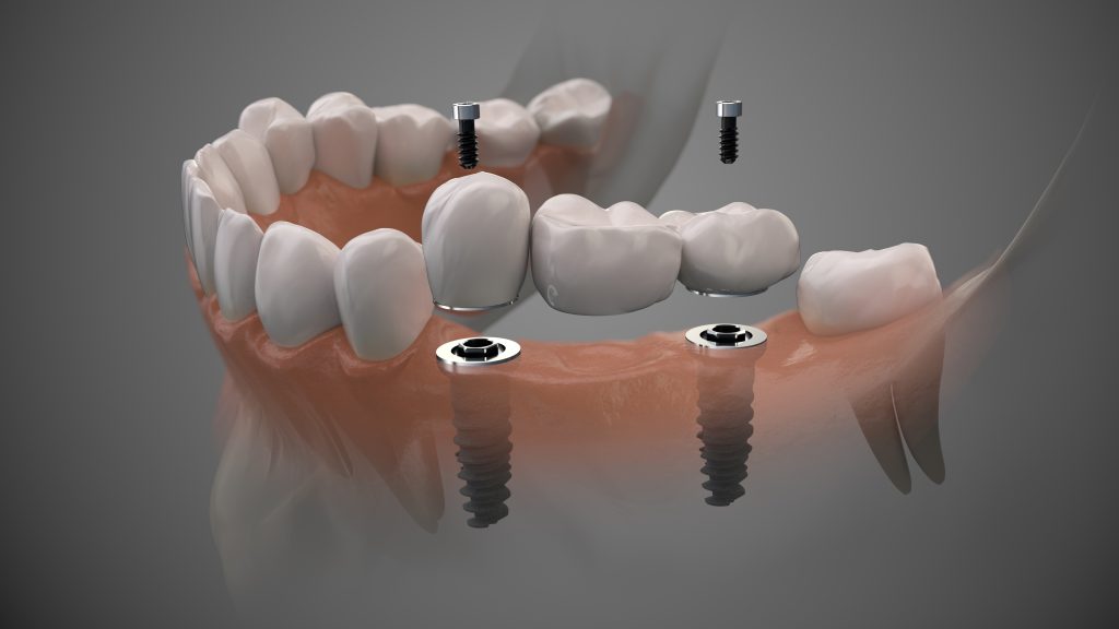 Dentist in North Palm Beach, Dentist in Palm Beach Gardens, Dentist in Juno Ridge, Dentist in Jupiter, Dentist West Palm Beach, Dentist in Lake Park, Dentist in Riviera Beach, Dentist in Cabana Colony, Dental Implant in North Palm Beach, Dental Implants in Palm Beach Gardens, Dental Implants in Riviera Beach, Dental Implants West Palm Beach, Emergency Dentist North Palm Beach, Emergency Dentist in West Palm Beach, Emergency Dentist in Palm Beach Gardens