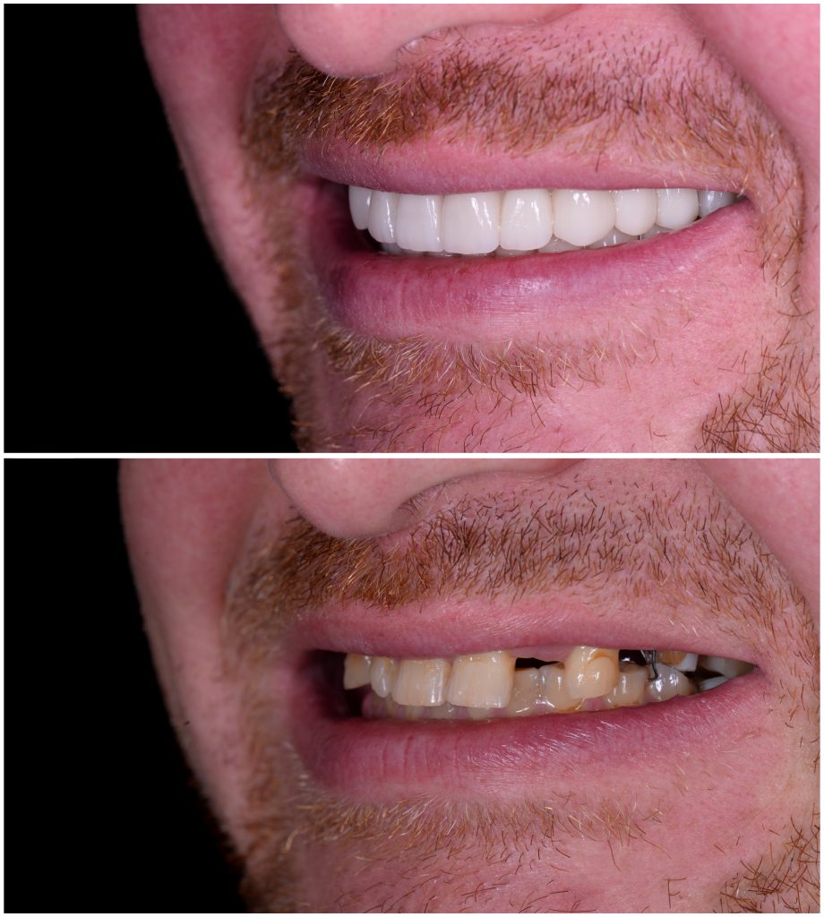 Dentist in North Palm Beach, Dentist in Palm Beach Gardens, Dentist in Juno Ridge, Dentist in Jupiter, Dentist West Palm Beach, Dentist in Lake Park, Dentist in Riviera Beach, Dentist in Cabana Colony, Dental Implant in North Palm Beach, Dental Implants in Palm Beach Gardens, Dental Implants in Riviera Beach, Dental Implants West Palm Beach, Emergency Dentist North Palm Beach, Emergency Dentist in West Palm Beach, Emergency Dentist in Palm Beach Gardens