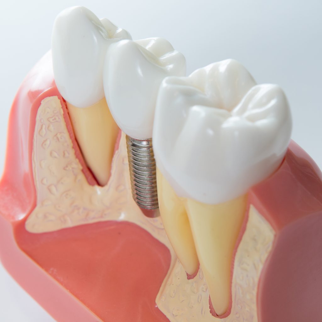 Dentist in North Palm Beach, Dentist in Palm Beach Gardens, Dentist in Juno Ridge, Dentist in Jupiter, Dentist West Palm Beach, Dentist in Lake Park, Dentist in Riviera Beach, Dentist in Cabana Colony, Dental Implant in North Palm Beach, Dental Implants in Palm Beach Gardens, Dental Implants in Riviera Beach, Dental Implants West Palm Beach, Emergency Dentist North Palm Beach, Emergency Dentist in West Palm Beach, Emergency Dentist in Palm Beach Gardens