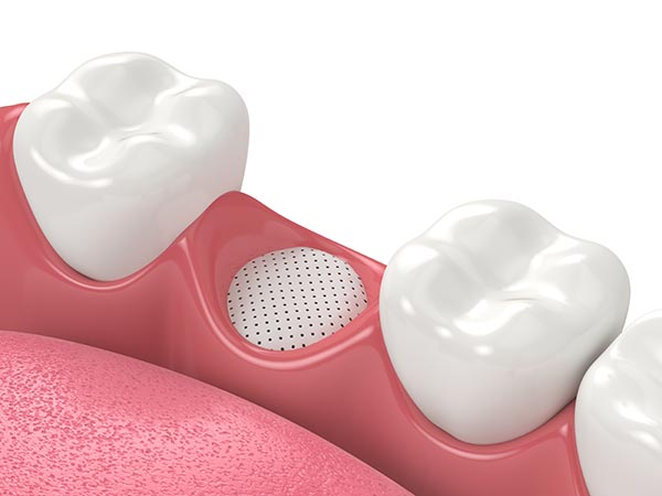 Socket preservation