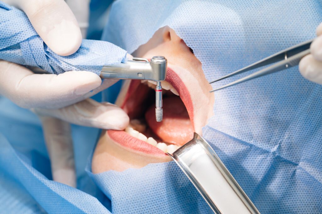 Same day dental implants